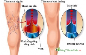 Thuốc trị giãn tĩnh mạch