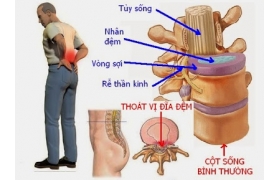 Chữa thoát vị đĩa đệm bằng đông y