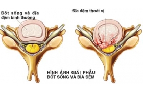 Chữa thoát vị đĩa đệm bằng thuốc nam